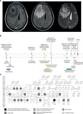 Constitutional mismatch repair deficiency syndrome with atypical features caused by a homozygous MLH1 missense variant (c.1918C>A, p.(Pro640Thr)): a case report